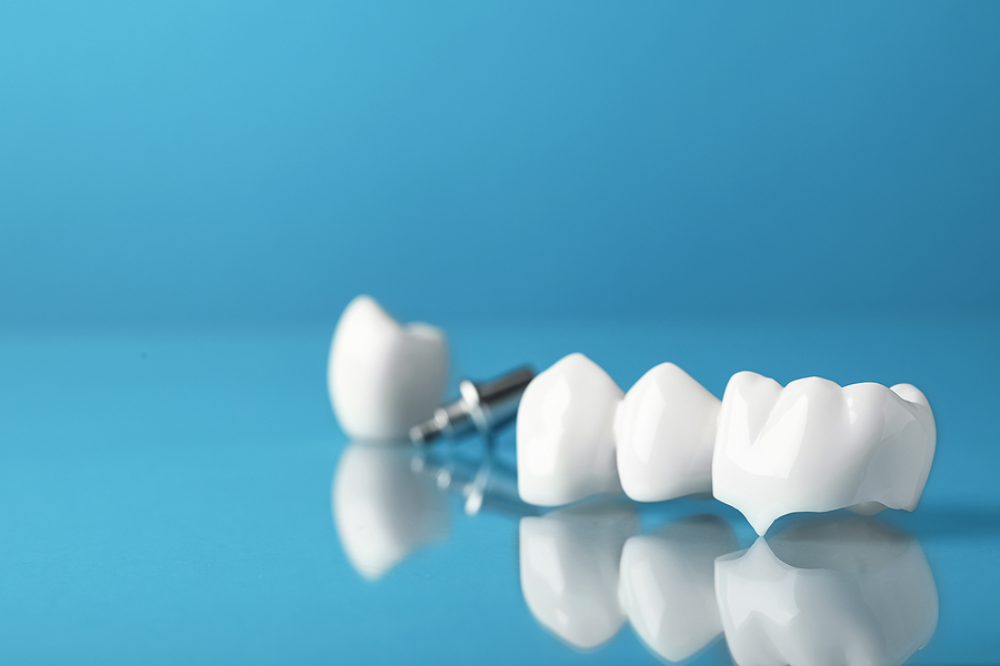 The Process for Getting a Dental Crowns